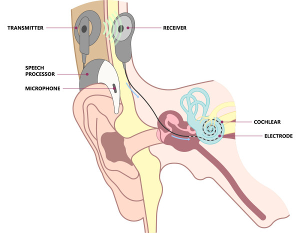 An illustration showing what a cochlear implant looks like.