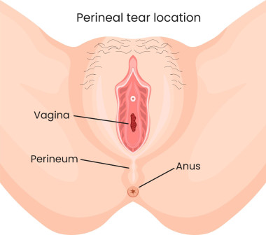 An illustration showing the location of a woman's perineum between the vagina and the anus. 