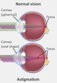 Medical illustration showing a normal eye with spherical shape cornea and an eye with astigmatism which shows an oval cornea