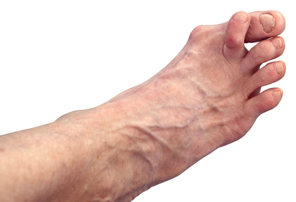 Photograph of a foot with overlapping toes