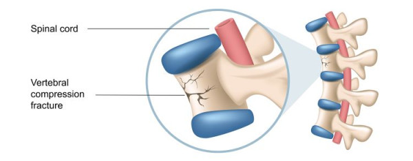 Spinal (vertebral) compression fracture Spinal compression fracture — anatomic illustration