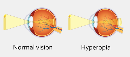 Eye illustration showing normal eye with focus on retina and an eye with hyperopia with focus behind the retina.