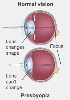 Medical illustration showing the lens shape change in a normal eye and an eye with presbyopia with no lens change
