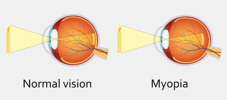 Eye illustration showing normal eye with focus on retina and an eye with myopia with focus in front of the retina.