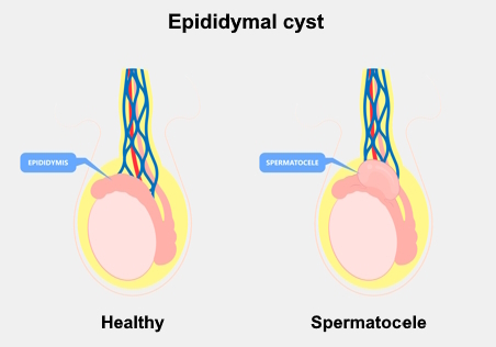 Anatomic illustration showing a healthy testicle and one with a cyst in the epididymis (spermatocele).