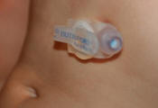Photo of an inserted peg tube